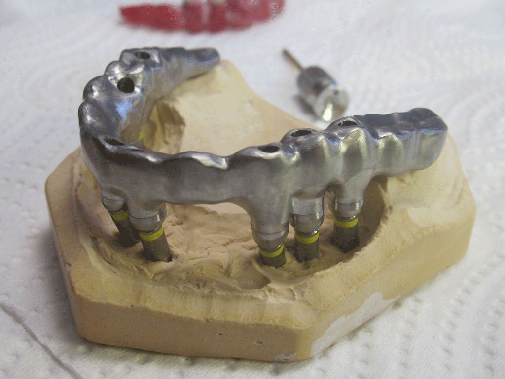 Cadcam Titanimplantatgerüst - Dentaltechnik G. Stutzer - Altdorf