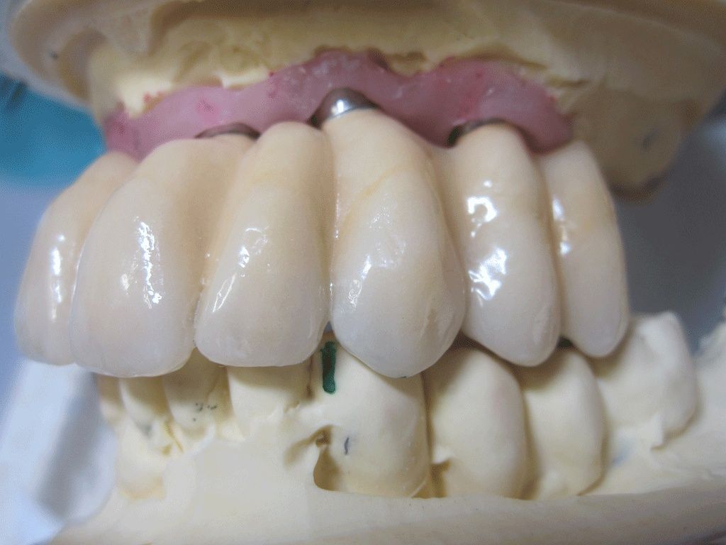 Goldkeramikimplantatbrücke ohne Zahnfleisch - Dentaltechnik G. Stutzer