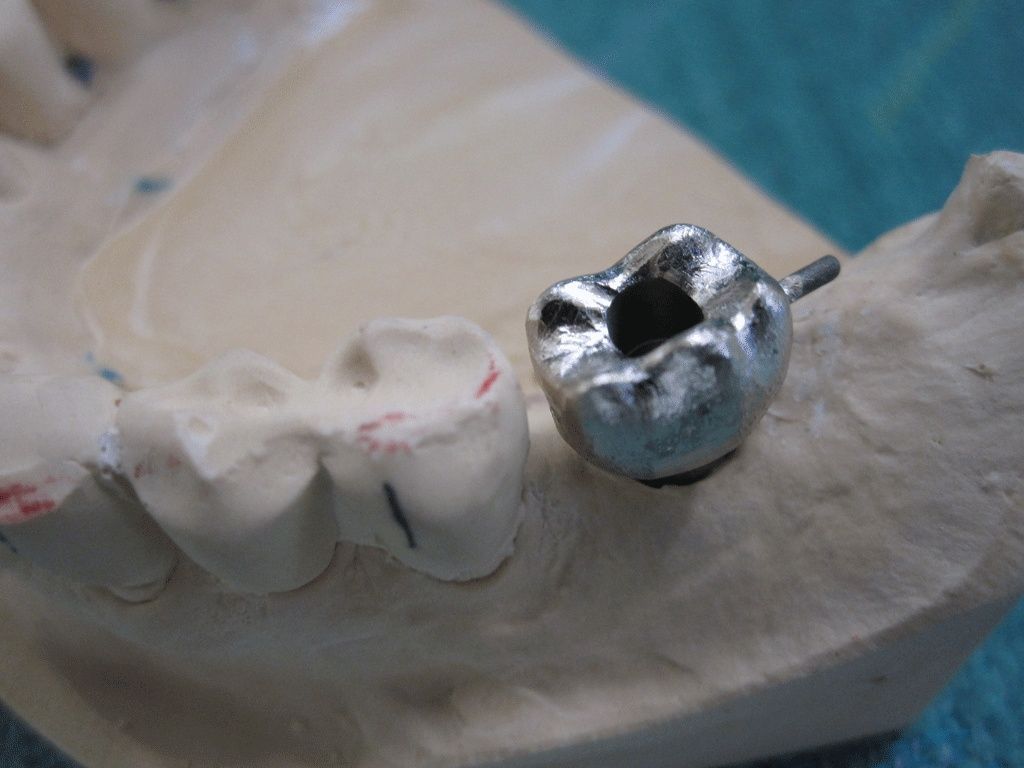 Goldgerüst vor Porzellanverblendung - Dentaltechnik G. Stutzer