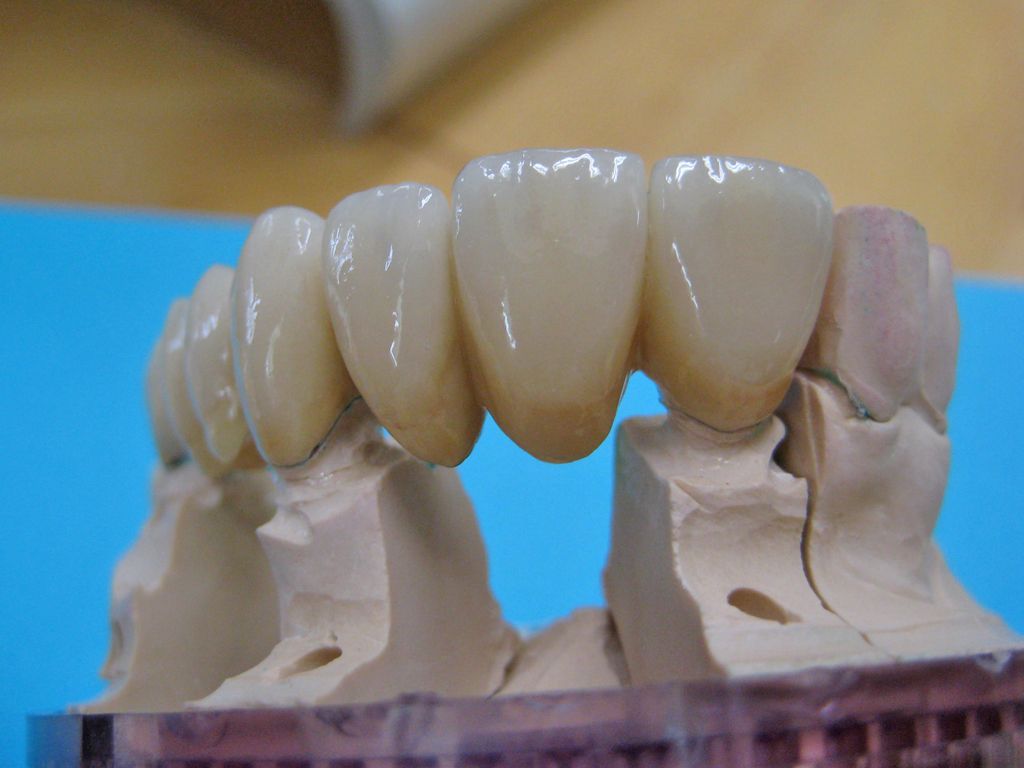 Goldkeramikbrücke / VMK-Brücke - Dentaltechnik G. Stutzer - Altdorf