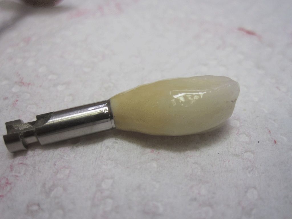 Goldkeramik-Implantatkrone - Dentaltechnik G. Stutzer - Altdorf