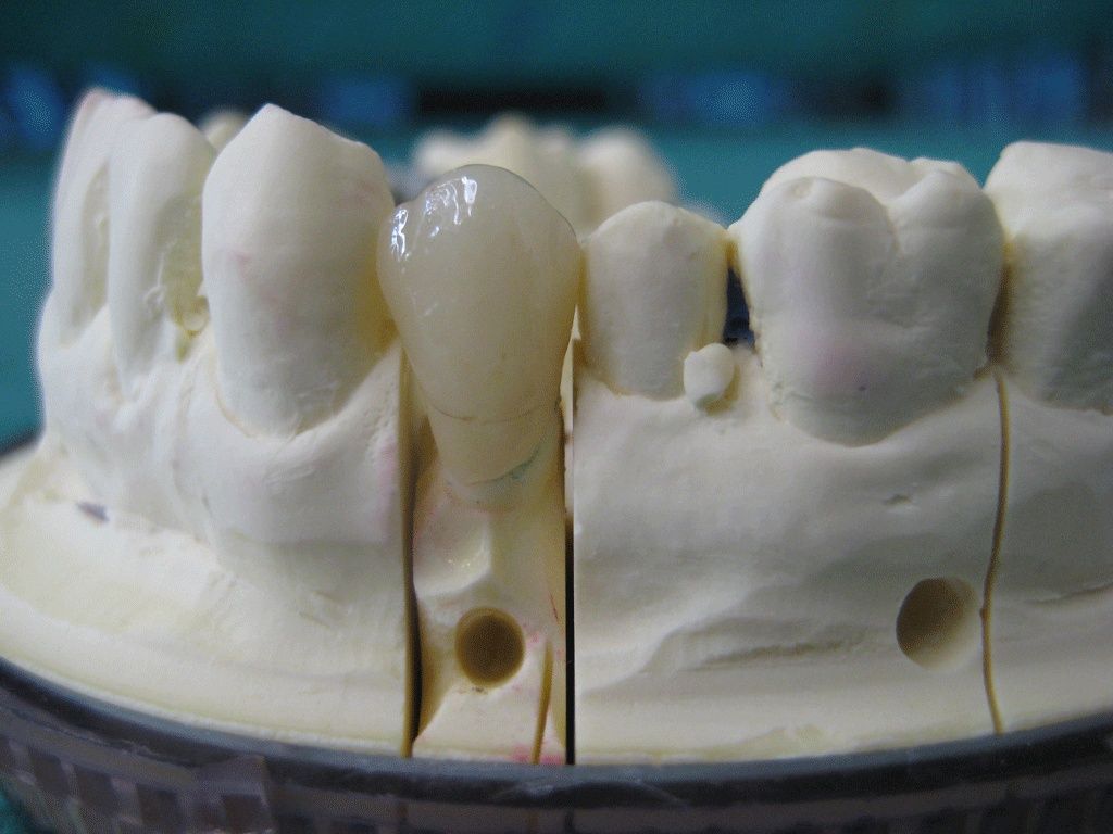 Vollkeramik-Krone - Dentaltechnik G. Stutzer - Altdorf