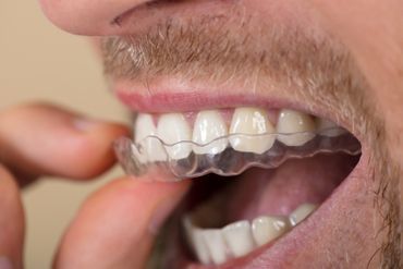 Mann setzt eine transparente Knirsch-Schiene ein