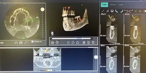Una tomografía computarizada de haz cónico (CBCT) dental en la pantalla de una computadora que muestra cortes transversales multivista de una mandíbula humana con una lesión quística grande.