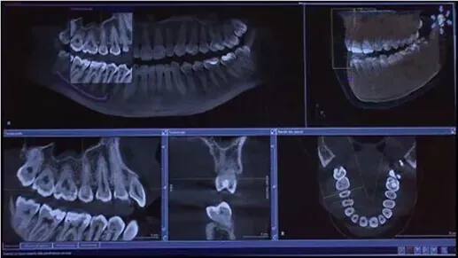 Tomografía computarizada de haz cónico (CBCT) dental que muestra múltiples vistas transversales de los dientes y la mandíbula de un paciente.