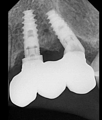 Radiografía dental que muestra dos implantes dentales conectados por un puente de tres unidades dentro del hueso maxilar.