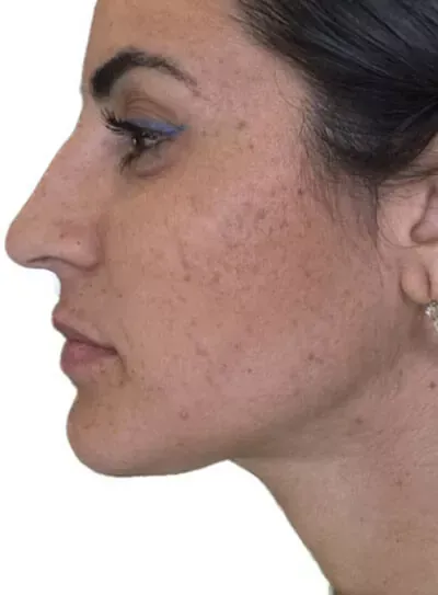 Perfil lateral del rostro de una persona, con énfasis en la textura de la piel y los rasgos faciales, sobre un fondo blanco liso.