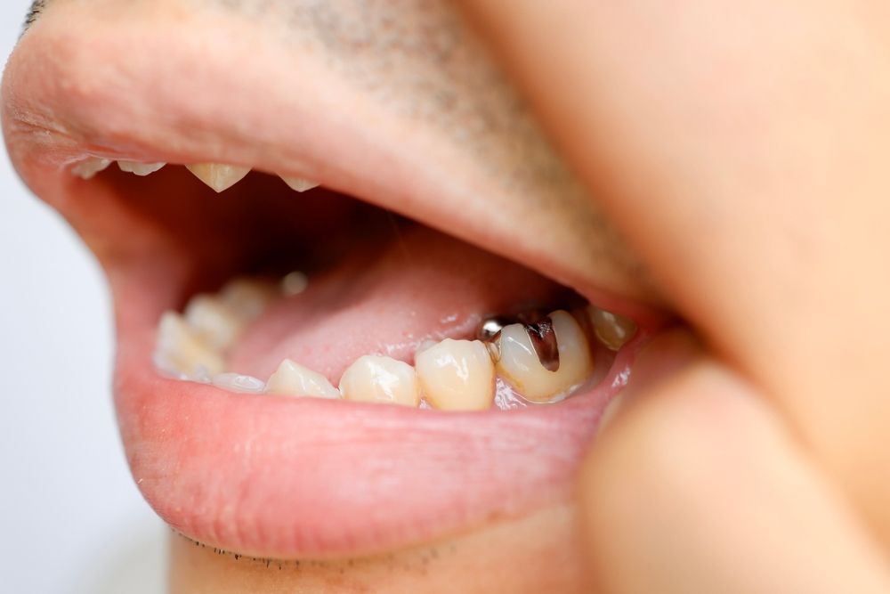 Primer plano de una boca abierta que muestra un molar inferior con una cavidad oscura y visible en la superficie de masticación.