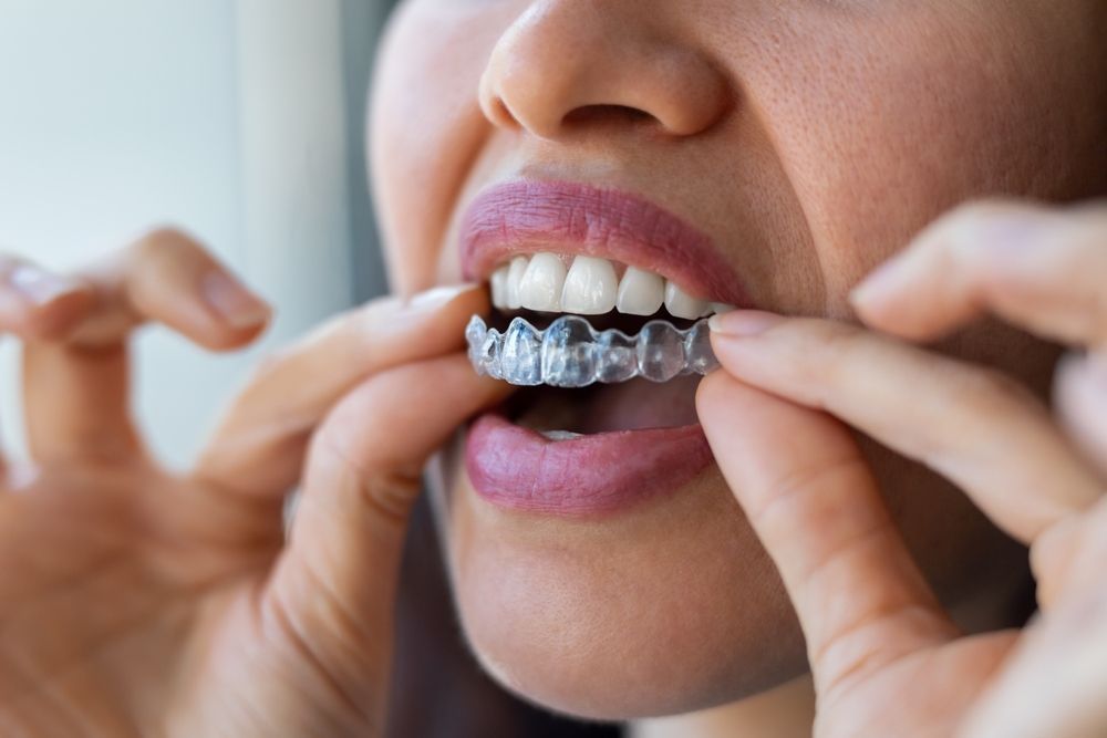 Una persona que utiliza ambas manos para colocarse un alineador dental de plástico transparente sobre los dientes inferiores.