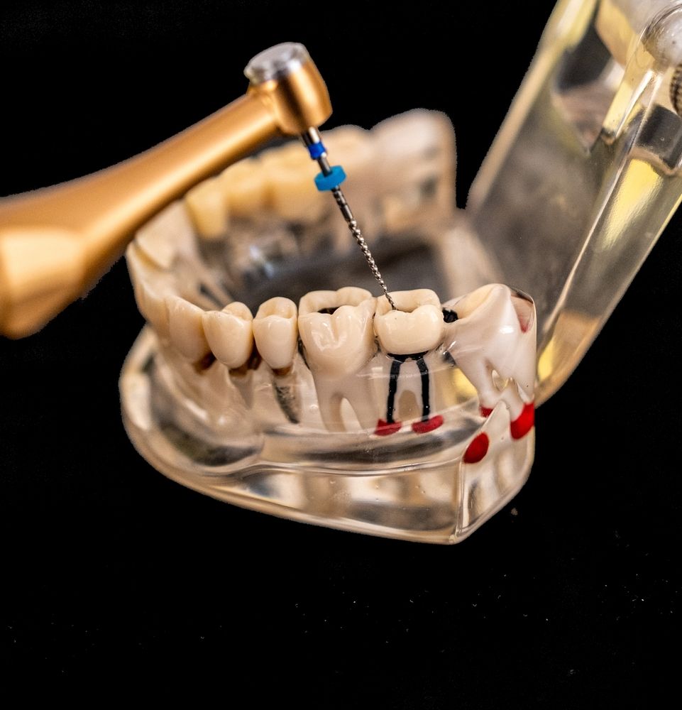 Una pieza de mano dental con una lima realiza un procedimiento de endodoncia en un modelo transparente de dientes inferiores.