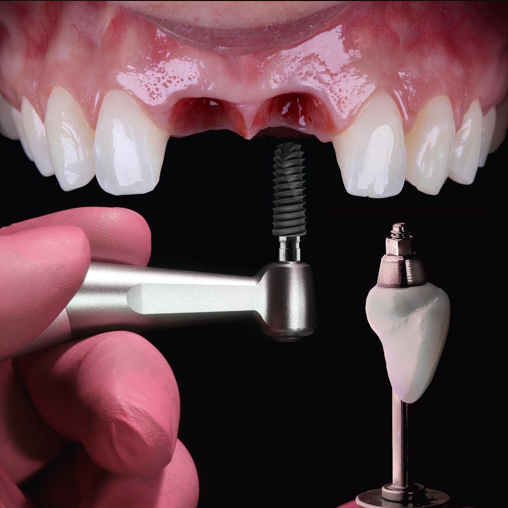 La mano enguantada de un dentista utiliza un instrumento para colocar un implante dental en la encía de un paciente, con una prótesis dental a la vista.
