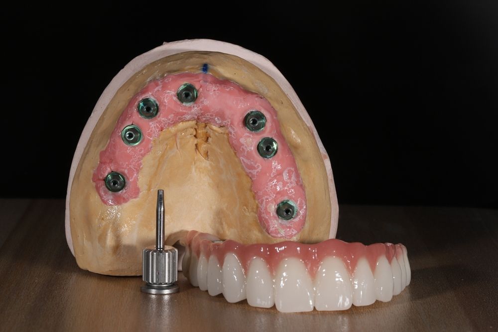 Un modelo dental con pilares implantados, un destornillador y una prótesis dental completa sobre un fondo oscuro.