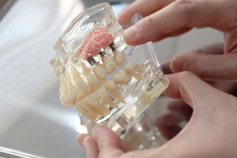 Manos que sostienen un modelo dental transparente que muestra un puente e implantes en la mandíbula superior.