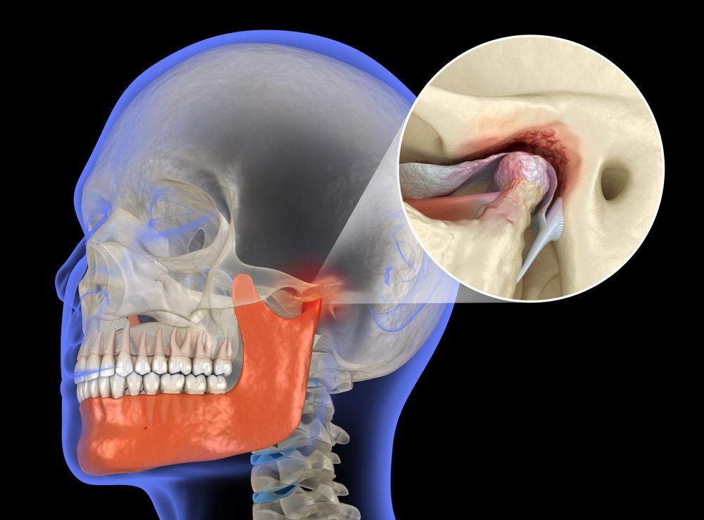 Vista transparente de un cráneo humano que resalta la articulación temporomandibular (ATM) en color naranja, con una ampliación de la articulación en el recuadro.