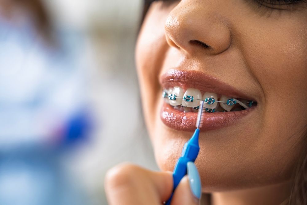Una persona utiliza un pequeño cepillo interdental azul para limpiar entre los dientes que llevan aparatos de ortodoncia metálicos.