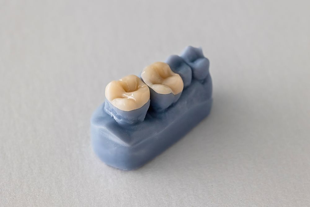 Un pequeño modelo azul de una sección de la mandíbula inferior que muestra dos molares blancos de aspecto realista.