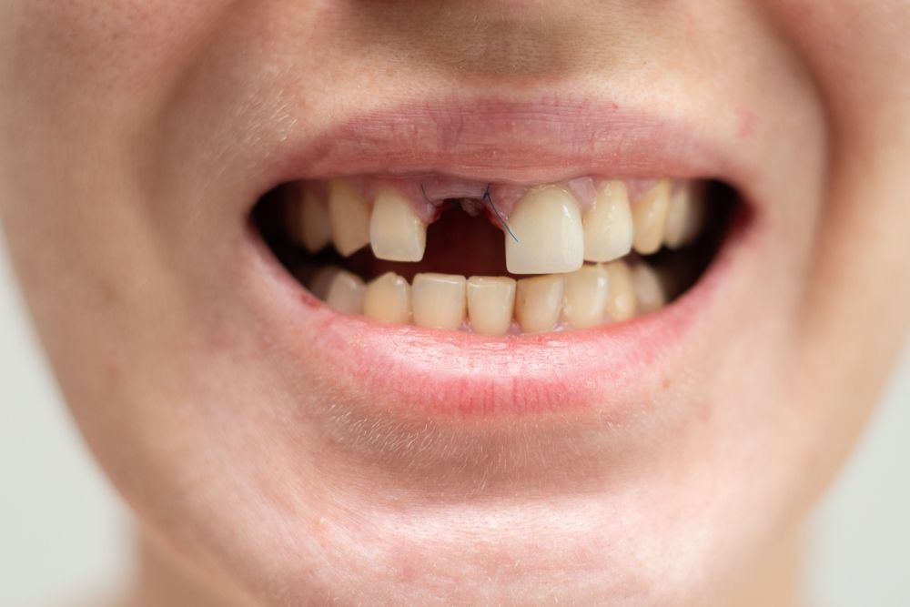 Primer plano de una boca que muestra la ausencia de un diente frontal superior, con una sutura visible en la zona de la encía.