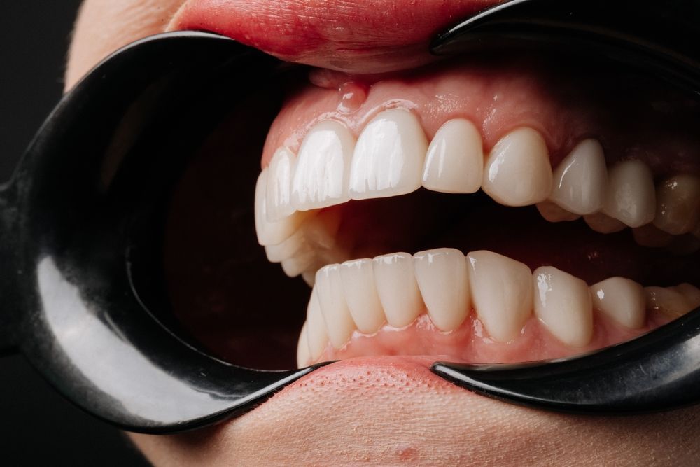 Primer plano de los dientes de una persona, mantenidos abiertos por un separador de mejillas negro para un examen dental.