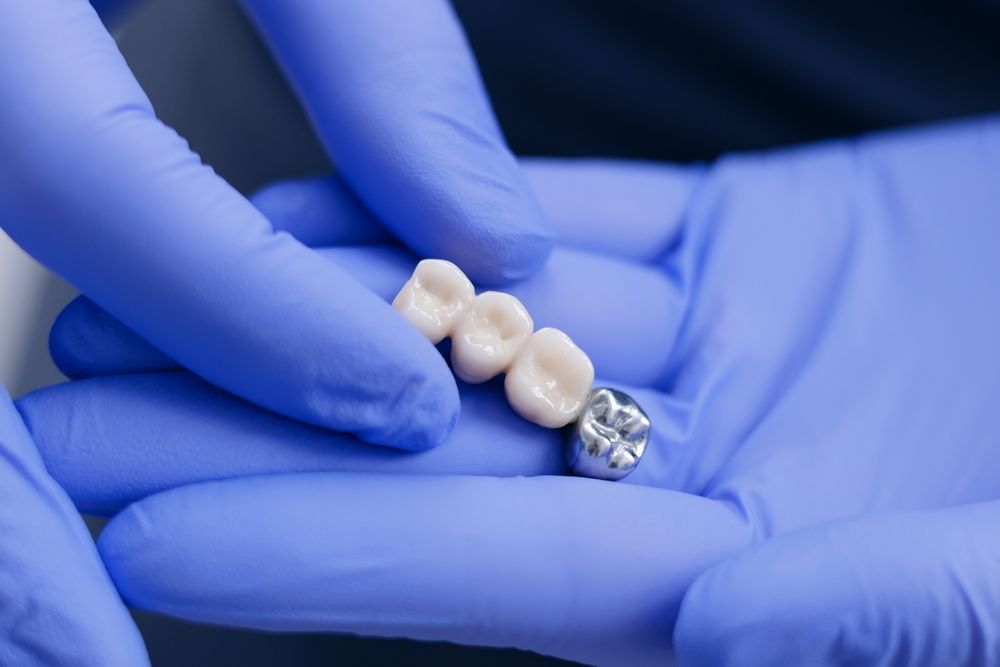 Una persona que lleva guantes médicos azules sostiene un puente dental con tres dientes de cerámica y una corona de metal.