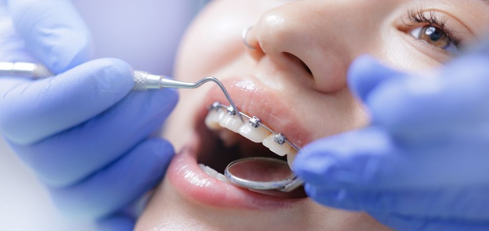 Un dentista, con guantes, utiliza un instrumento dental y un espejo para examinar los dientes de un paciente que lleva aparatos de ortodoncia.