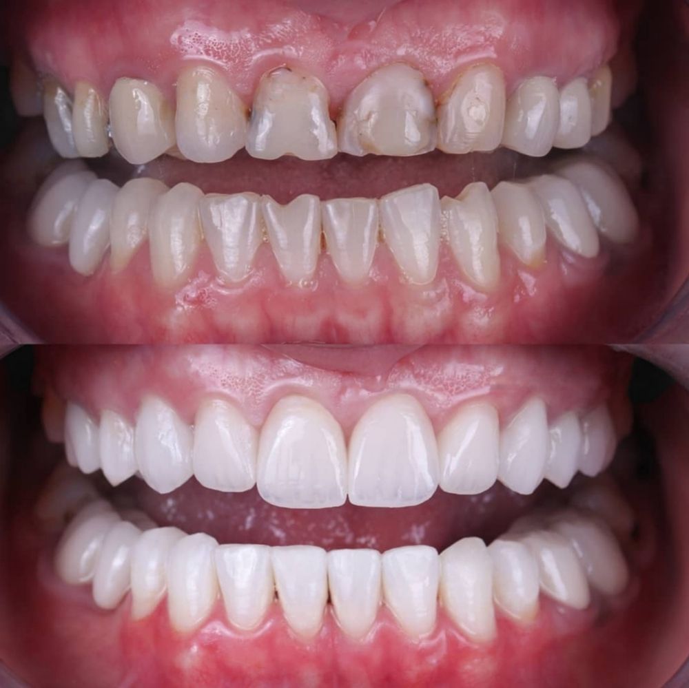 Comparación de los dientes antes y después, mostrando la fila superior con decoloración y la fila inferior blanqueada y alineada.