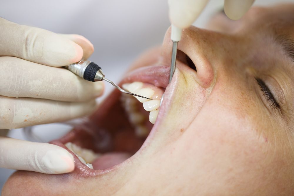 Un profesional dental, con guantes, utiliza un instrumento de limpieza dental para limpiar los dientes de un paciente que está tumbado en una silla.