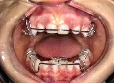 Primer plano de una boca abierta que muestra los retenedores o aparatos de ortodoncia metálicos superiores e inferiores colocados en los dientes.