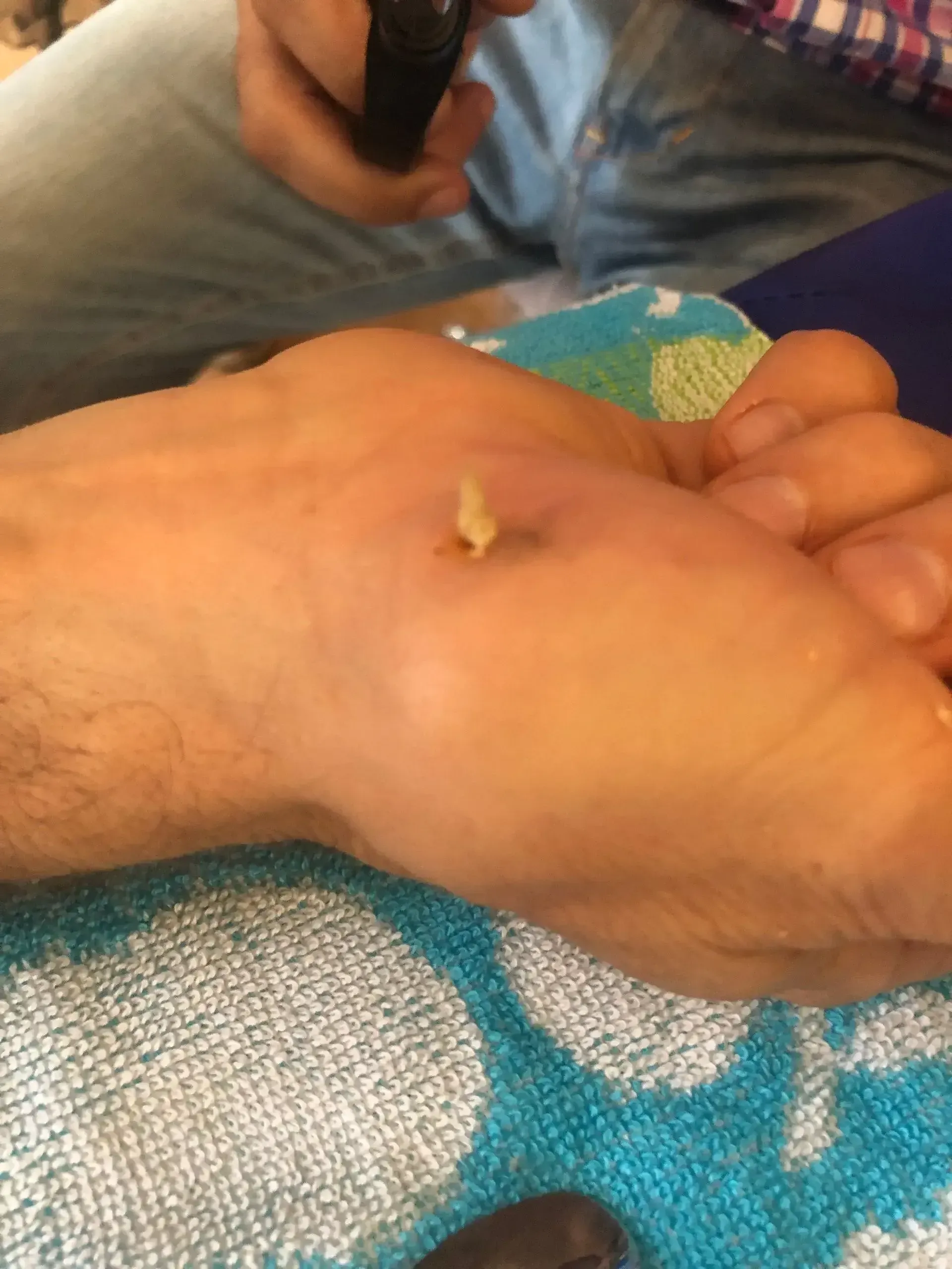 Primer plano de un pie con un crecimiento amarillento y elevado en la planta, posiblemente una verruga, con una persona sosteniendo un dispositivo.