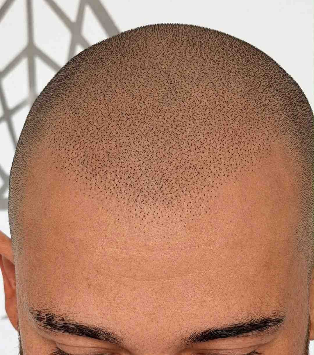 Primer plano de una cabeza rapada y la frente, con las cejas visibles en la parte inferior.