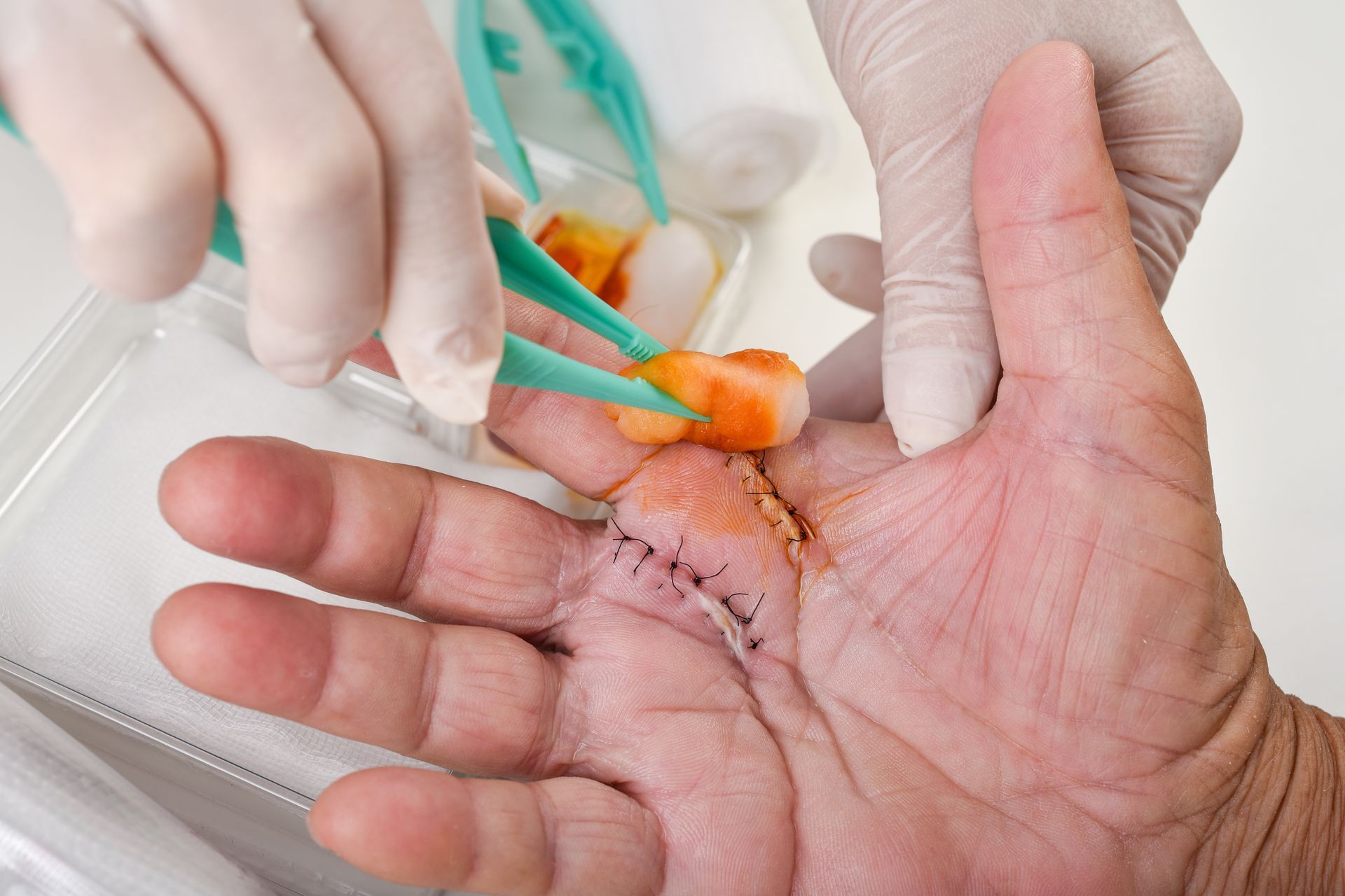 Des mains gantées nettoient une paume suturée avec un tampon antiseptique orange.