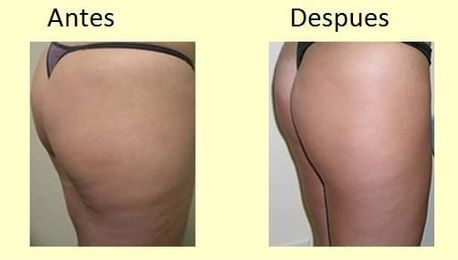 Fotografías de antes y después del muslo y el trasero de una mujer, que muestran una reducción de la celulitis después del tratamiento.
