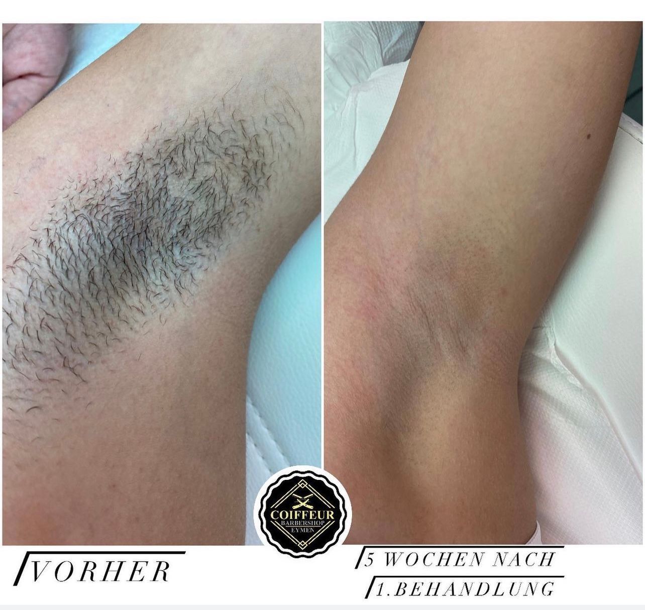 Eymen Coiffeur & Beauty GmbH – Entfernung der Achselhaare
