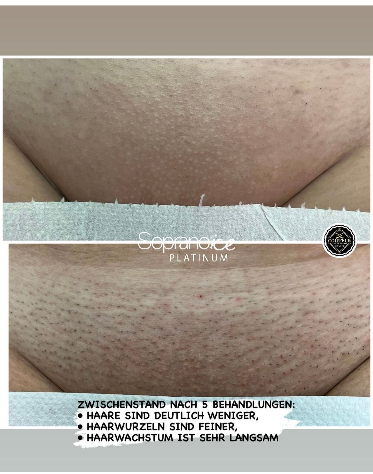 Eymen Coiffeur & Beauty GmbH – Intimhaarentfernung
