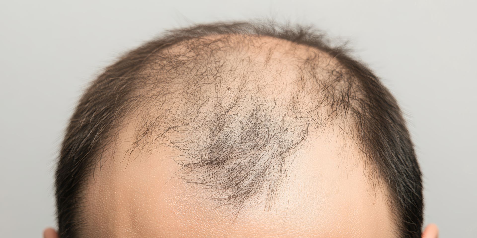 Gros plan sur crane sans cheveux
