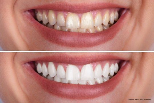 Vorher-nachher-Bild weiße Zähne