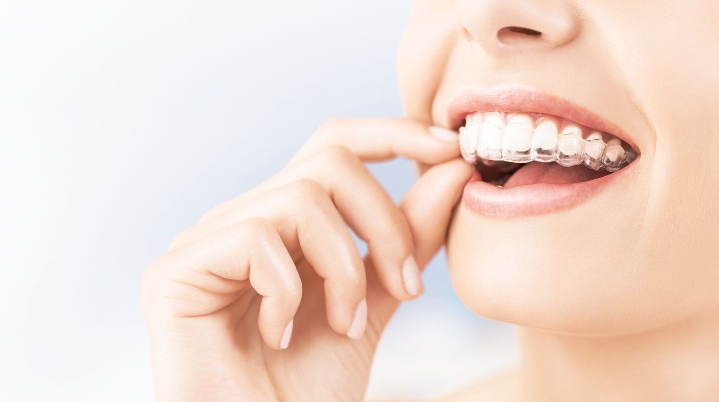 Lächelnde Frau, die einen durchsichtigen Invisalign-Aligner aus ihren Zähnen entfernt. Heller Hintergrund.