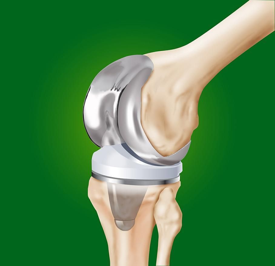 gonarthrose - Dr Latif Vaqar