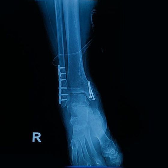 fractures de chevilles - Dr Latif Vaqar