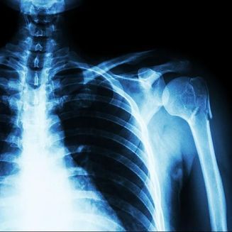 Fracture de l’épaule - Dr Latif Vaqar