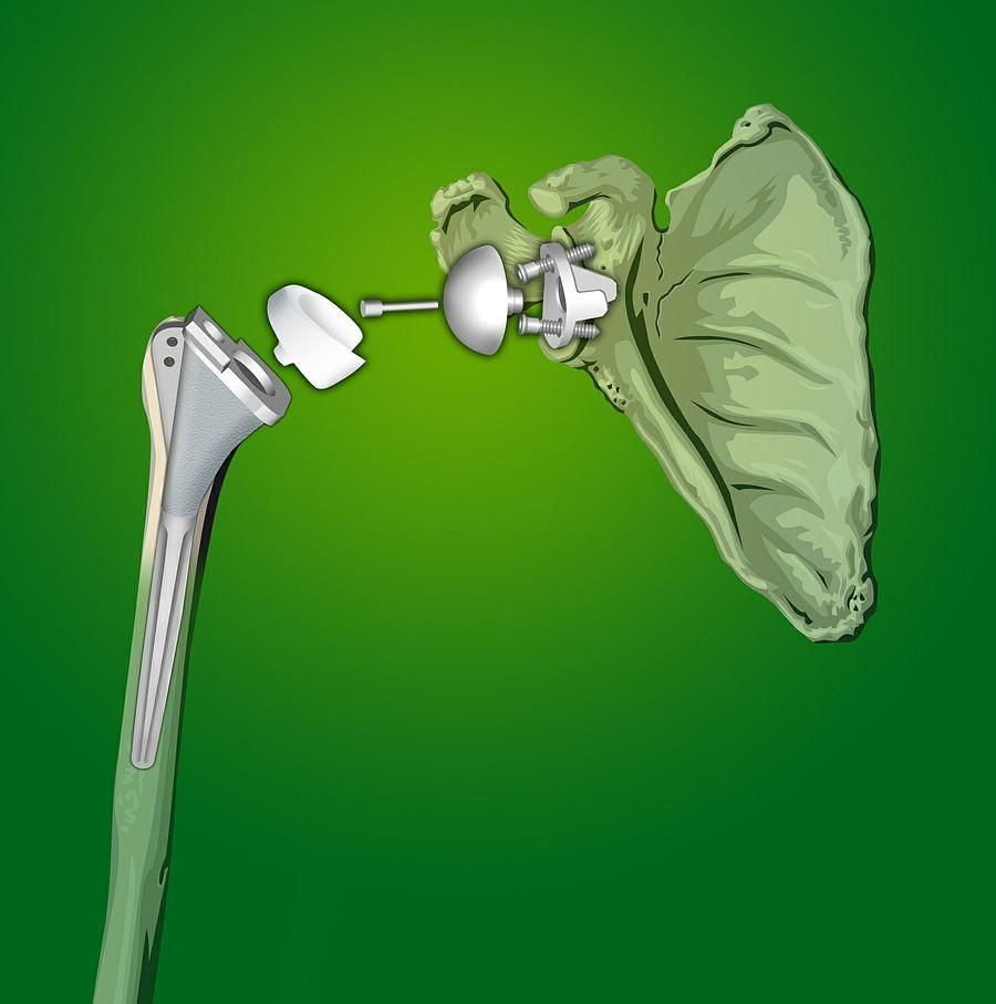 Arthrose de l'épaule - Dr Latif Vaqar