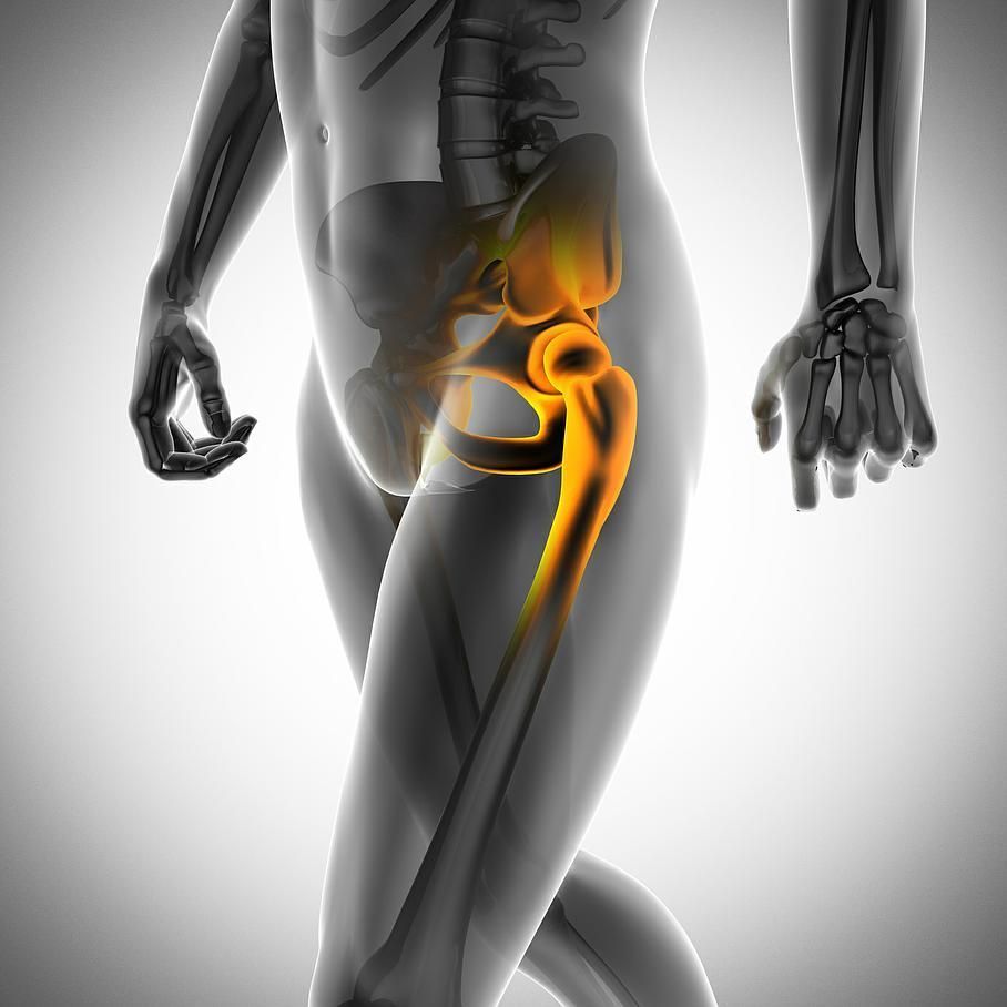 coxarthrose - Dr Latif Vaqar