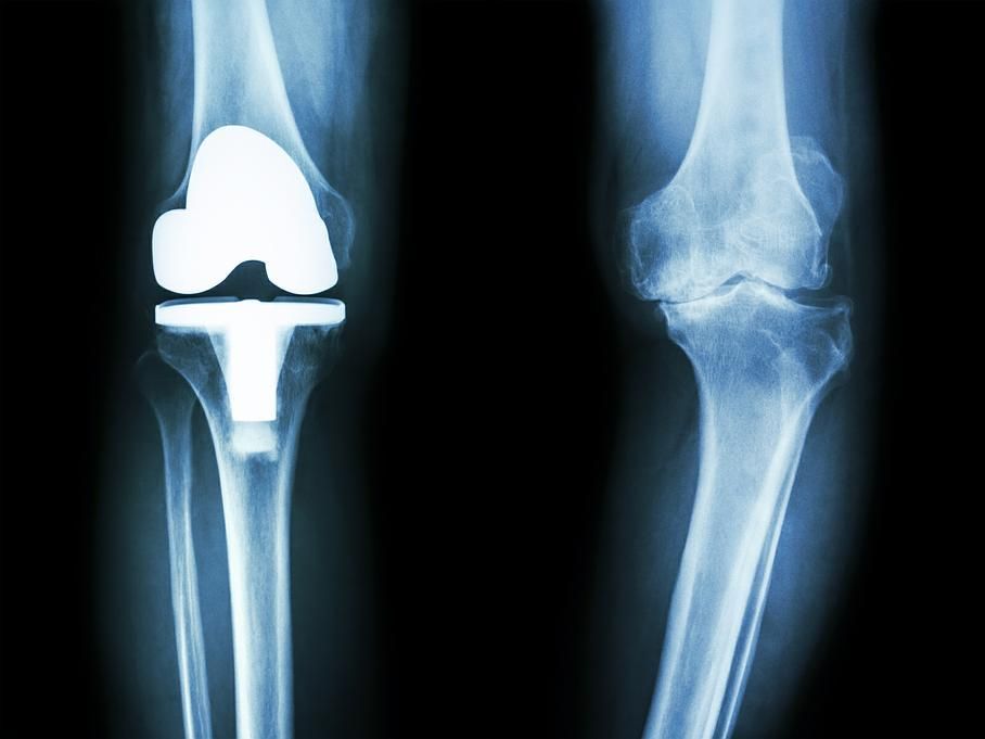 arthrose du genou - Dr Latif Vaqar