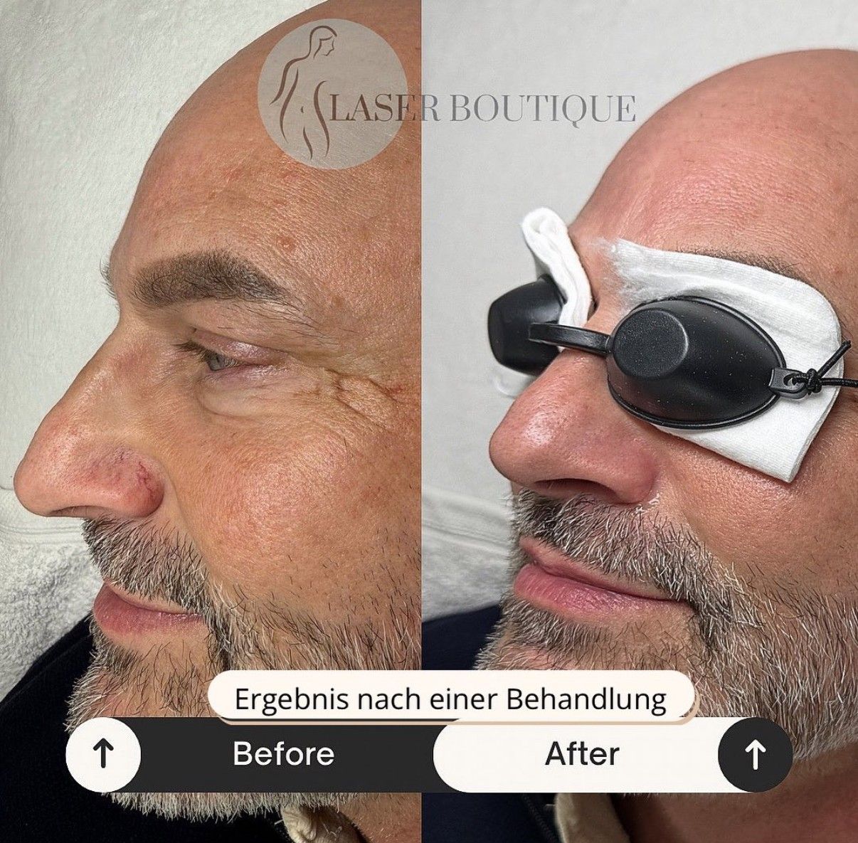 Ein Vorher-Nachher-Foto eines Mannes mit Schutzbrille