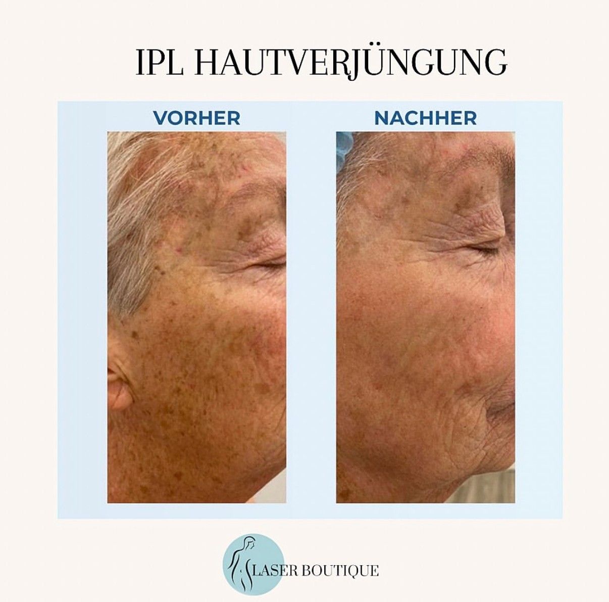 Ein Vorher-Nachher-Bild des Gesichts einer Frau.