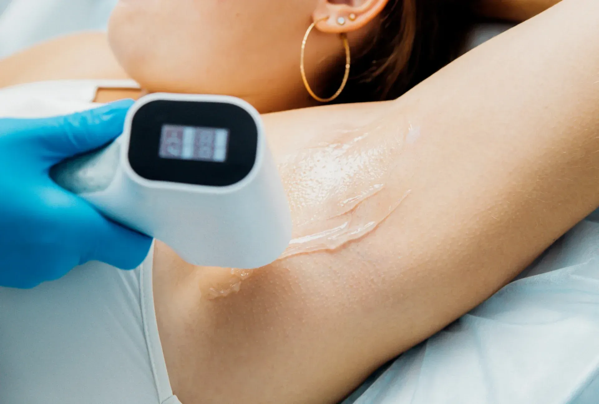 Axila tratada con láser. Mano con guante azul sujeta el dispositivo y aplica gel. Aro dorado visible.