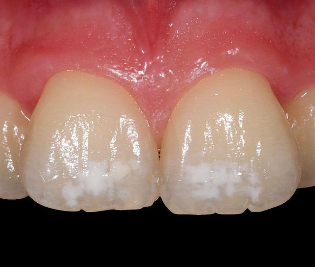 Gengivas Brancas Manchas Brancas Na Boca: 6 Causas E O Que Fazer