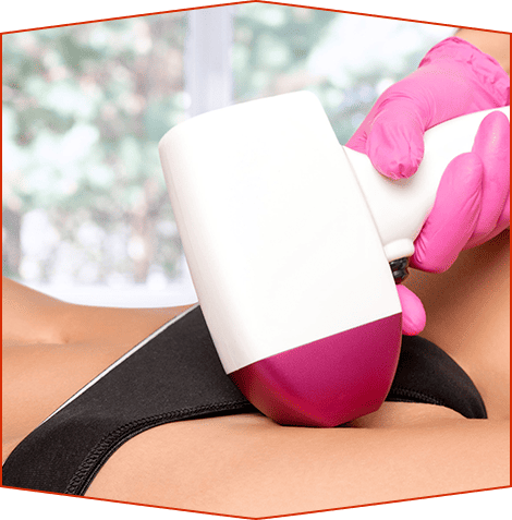 Una mano con un guante médico rosa utiliza un dispositivo de depilación láser portátil de color blanco y magenta en la línea del bikini de una persona.