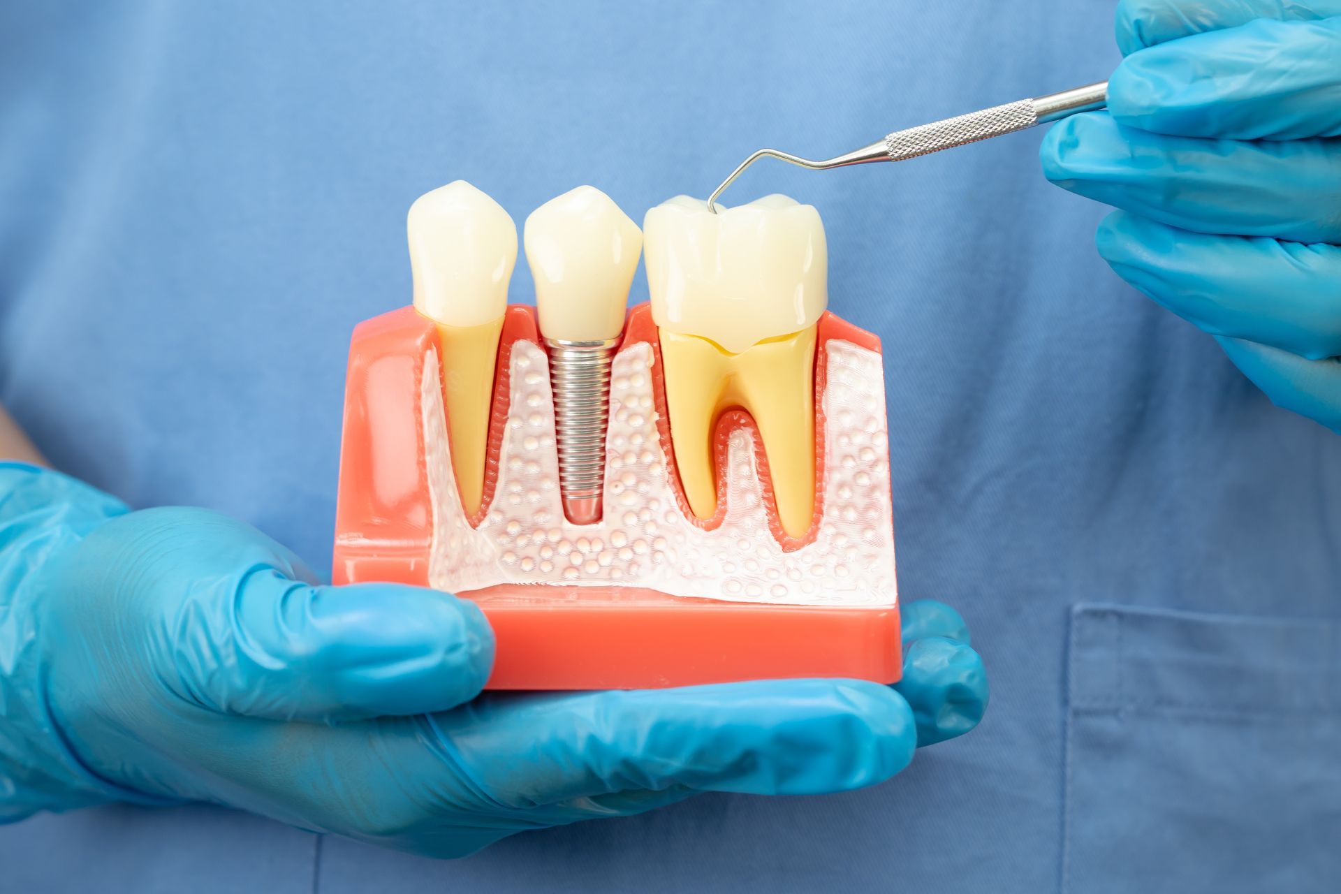 Zahnimplantate stützen künstliche Zähne in einer Kieferillustration. Zeigt Implantate und Brücken.