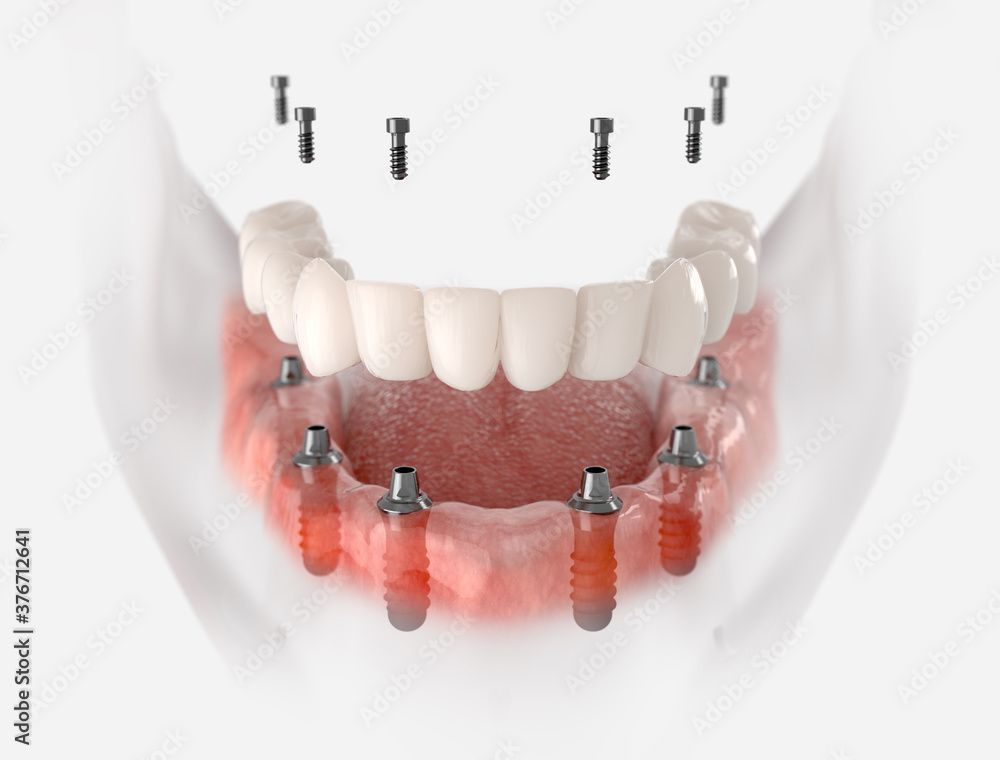 Abbildung der Zahnimplantatbehandlung: Kiefer mit neuen Zähnen, Implantaten und losen Schrauben.