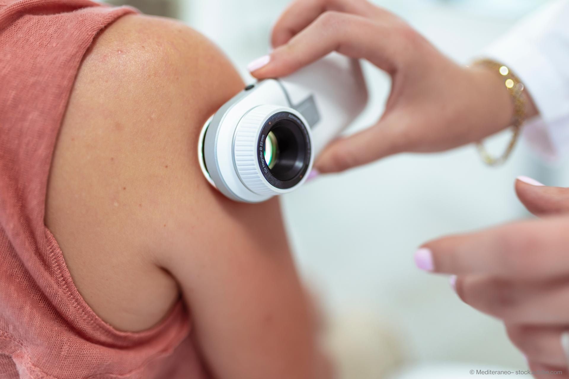 Eine Ärztin führt eine Hautkrebsuntersuchung bei einer jungen Frau durch